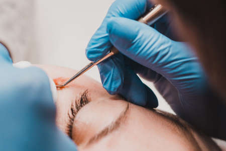 Milium on the face, removal of milia with a syringe in cosmetology. new