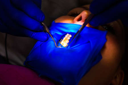 Treatment of the upper sixth left tooth, sterile treatment with roofing felt. new