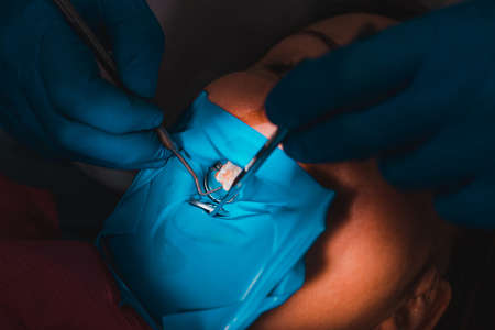 Treatment of the upper sixth left tooth, sterile treatment with roofing felt. newの写真素材