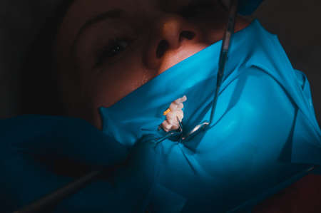 Close-up of the patient's mouth after filling the teeth with white composite resin on the insulation of a rubber dam, rubber dam and dental mirror. newの写真素材