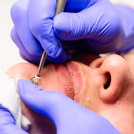 The beautician cleanses the patient's skin with a spoon uno, moisturizing, cleansing and skin care. newの写真素材