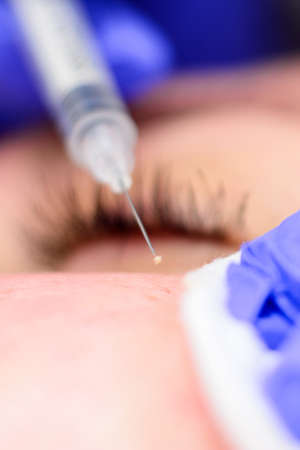 Removal of milia on the face with a syringe, cosmetic procedure on the face. newの写真素材