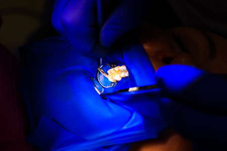 Dental procedure, treatment of the upper masticatory tooth, modern dental treatment with a rubber...