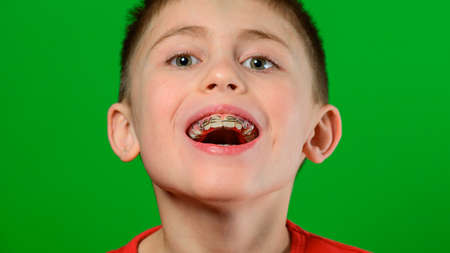 A boy of Caucasian nationality demonstrates a plate for straightening crooked and deformed teeth....