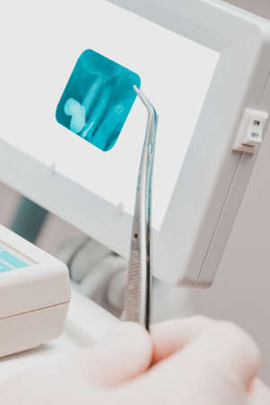 The dentist holds an X-ray of several teeth, diagnosis and evaluation of teeth with an X-ray, X-ray of three teeth.の写真素材
