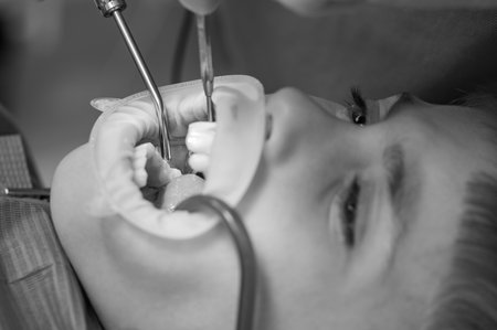 Dentist cleans tooth decay in a child with a drill, in the mouth of a child ejector saliva, dental treatment close up, dental retractor on the lips of a boy.の写真素材