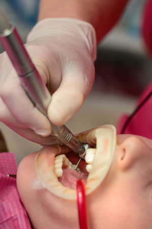 Dentist cleans tooth decay in a child with a drill, in the mouth of a child ejector saliva, dental treatment close up, dental retractor on the lips of a boy.の写真素材