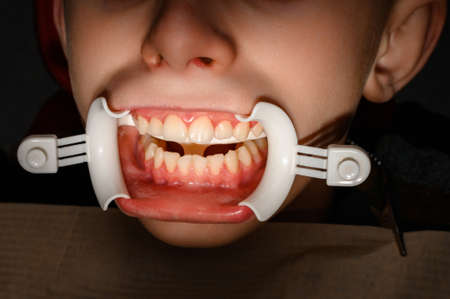 Plastic retractor for lip augmentation in the mouth, dental procedure and retractor as an auxiliary...