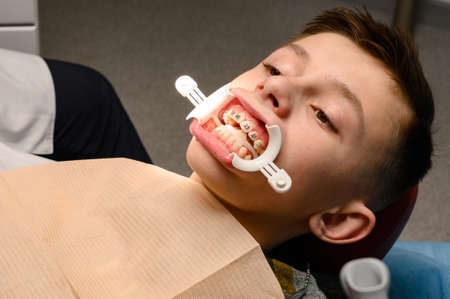 Visit to the orthodontist, installation of braces on the upper teeth, white retractor on the lips of the child, alignment of the teeth.の写真素材