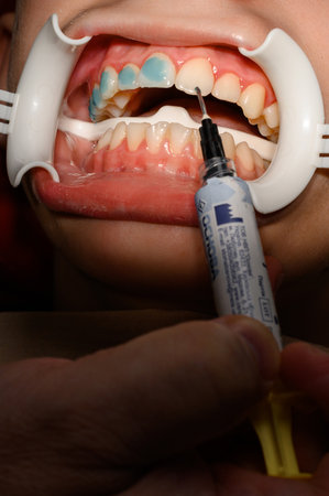 Ivano-Frankivsk, Ukraine February 3, 2022: applying glue to teeth to stick braces, align teeth with braces, basis for braces.のeditorial素材