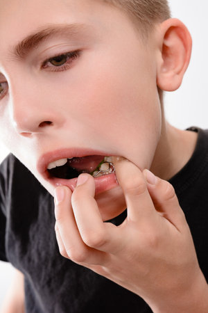 A detailed close-up shot focusing on a young person's mouth. They are wearing a metal retainer. The...
