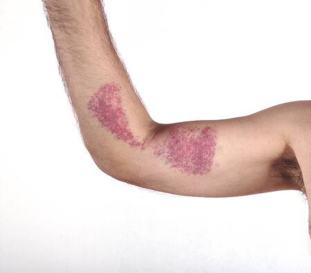 Man's hand with hematoma on  white backgroundの写真素材