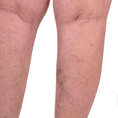 Female legs with varicose veins and leg spiders.の写真素材