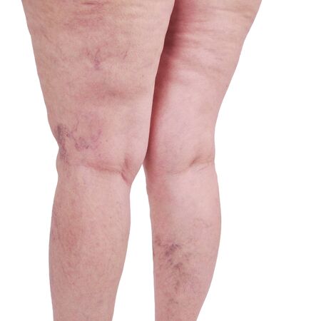 Female legs with varicose veins and leg spiders.の写真素材