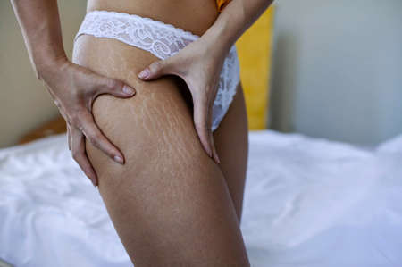 Female Hip Stretch Marks On Woman's Legsの写真素材