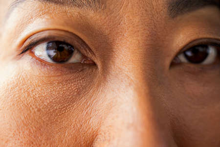 Asian Woman With Under Eye Bag. Puffy Eye Of Girl Showing Eyes Bags.