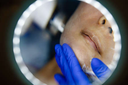 Face Having A Laser Skin Treatment, A Resurfacing Technique For Wrinklesの写真素材