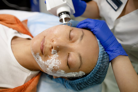 Face Having A Laser Skin Treatment, A Resurfacing Technique For Wrinklesの写真素材