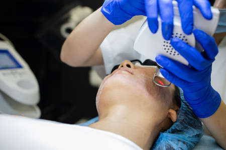 Face Having A Laser Skin Treatment, A Resurfacing Technique For Wrinklesの写真素材