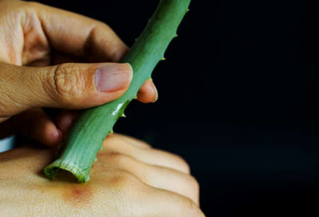 Female Hand Applying Aloe Vera Gel On A Skin Burn.の写真素材