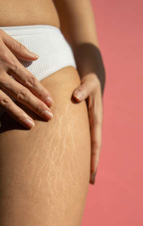 Close up female legs with stretch marks on pink background.の写真素材