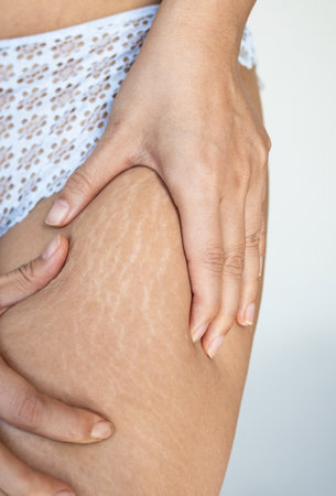 Stretch marks on female legs. A woman's hand holds a fat cellulite and a stretch mark on her leg. cellulite.の写真素材