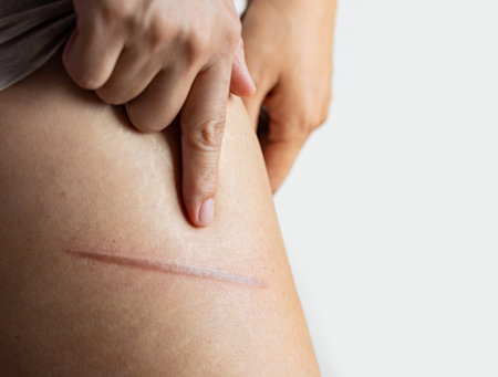 Female leg with thermal burn of the skin. Domestic injury during ironing or cooking. Scars on the legs's woman.の写真素材