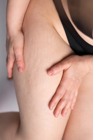 Woman compressing the skin on her legs checking for cellulite and excess subcutaneous fat. A woman showing her stretch marks on her hips. Female thighs with stretch marks.の写真素材