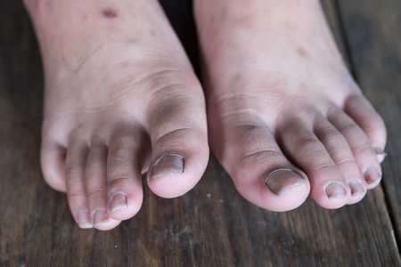 Close up of fungus infection on nails foot, Selective focus of dirty finger nails.の写真素材
