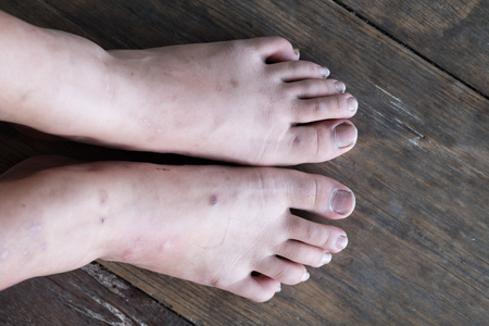 Close up of fungus infection on nails foot, Selective focus of dirty finger nails.の写真素材