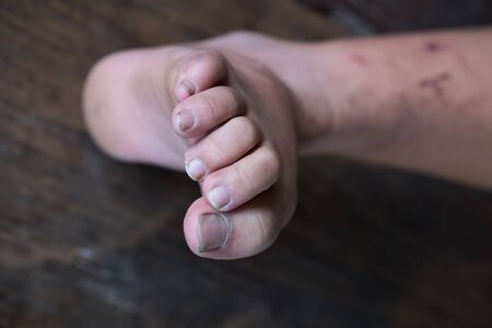 Close up of fungus infection on nails foot, Selective focus of dirty finger nails.