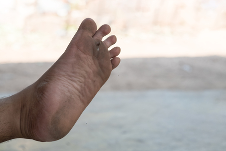 Closeup of foot with a Infection of the feet caused by fungus.の写真素材