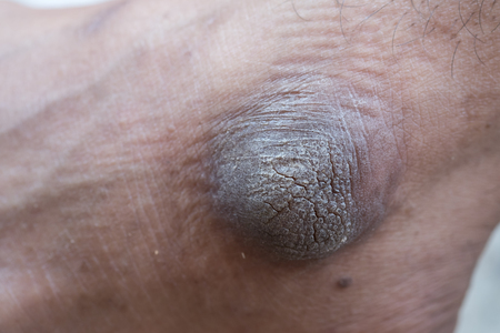 Closeup of foot with a Infection of the feet caused by fungus.の写真素材