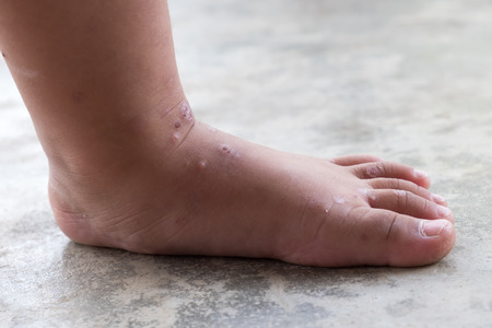 Itchy dermatitis atopic baby foot. Close up Infected wound.Opened wound at left leg.の写真素材