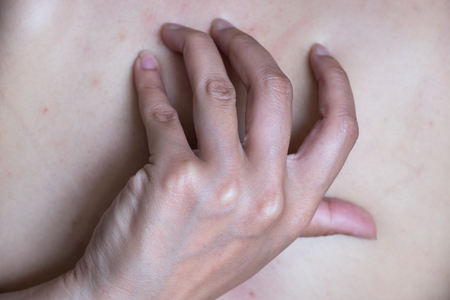 Acne, dermatitis. Acne On The Back.の写真素材