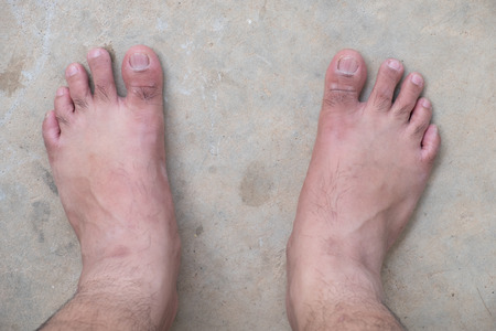 Lap Feet Or Flat Foot. Health & Foot Care, Closeup cracked heels and varicose veins.