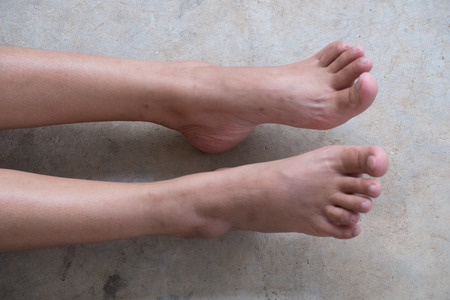 Lap Feet Or Flat Foot. Health & Foot Care, Closeup cracked heels and varicose veins.の写真素材