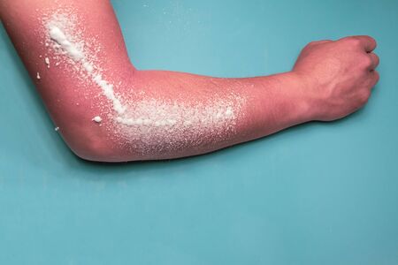The man got a burn in the sun. Foam processed tanの写真素材