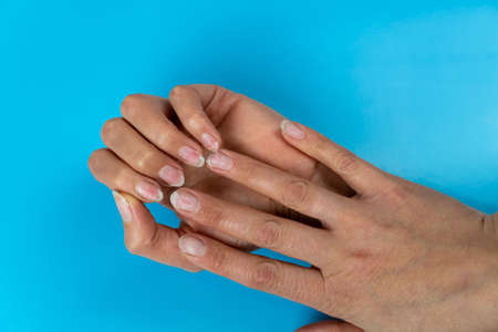 Female hands with nails affected by fungus on a blue background. Hand health and hygiene. Free space...