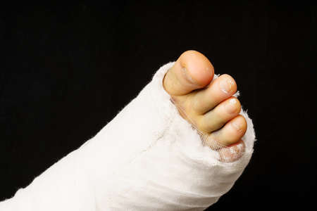 A leg in a plaster cast with a black background. Close-upの写真素材
