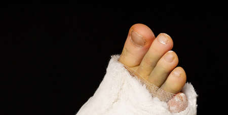 close-up of a leg in a plaster cast on a black background