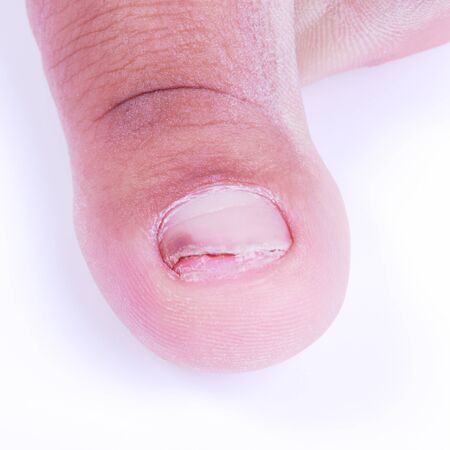 Ingrown nail caused by improper cleaning and cut nails.の写真素材