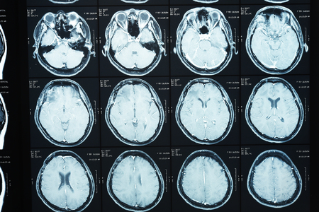 images from a computerized tomography of the brain