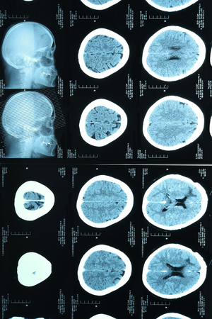 images from a computerized tomography of the brainの写真素材