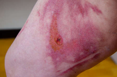 Thermal burn of the skin in the healing stage. Burnt skin on the thigh, domestic injury from boiling water, close-up. Second degree burn. selective focusの写真素材