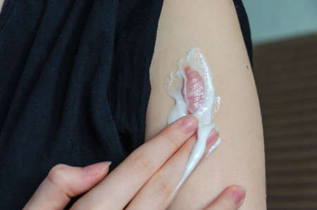 Applying cream to remove the scar. Close-up of a keloid scar on the shoulder of a young woman. Removal of formations on the skin.の写真素材