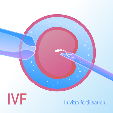 IVF. Artificial insemination. Realistic vector design 3dのイラスト素材