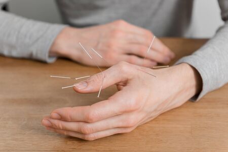 Man using acupuncture treatment for pain relief. Chinese alternative medicineの写真素材