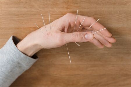 Man using acupuncture treatment for pain relief. Chinese alternative medicineの写真素材