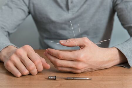 Man using acupuncture treatment for pain relief. Chinese alternative medicineの写真素材